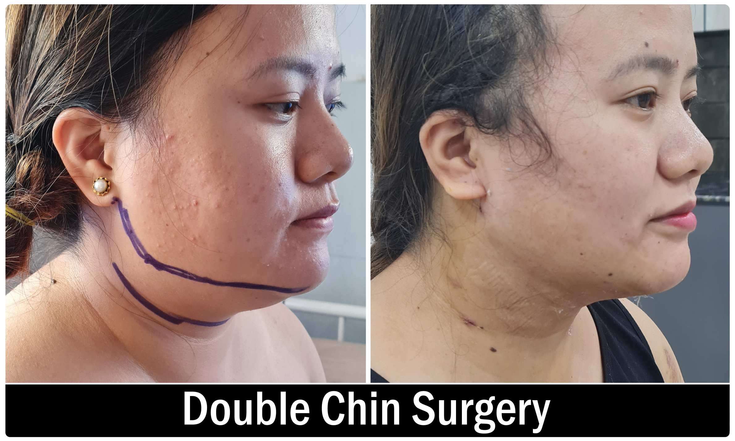 Double Chin Surgery KOQ10